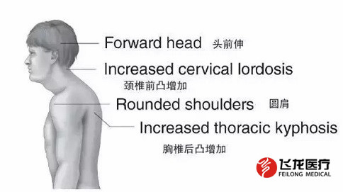 脊柱健康，不向生活“低頭”