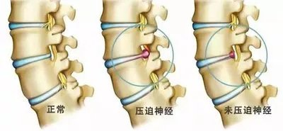椎間盤(pán)病變對(duì)比